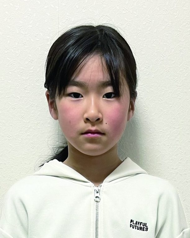 施術後のお顔（目線を入れて掲載しています）